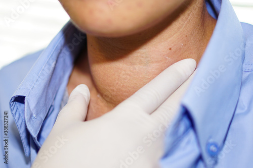 Εκτύπωση καμβά Asian lady woman patient have abnormal enlargement of thyroid gland Hyperthyroid