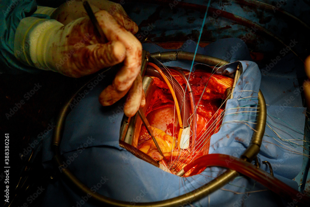Patient during a heart surgery at a hospital in the surgical operating room