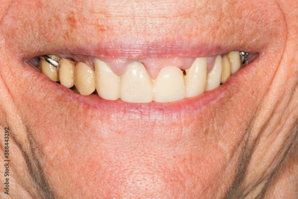 Obraz premium Peri-implantitis : Diseases that cause loss of bone around the dental implant