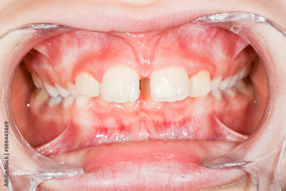 Fototapeta premium Open child mouth with gap between tooth macro. Dental doctor check state of teeth