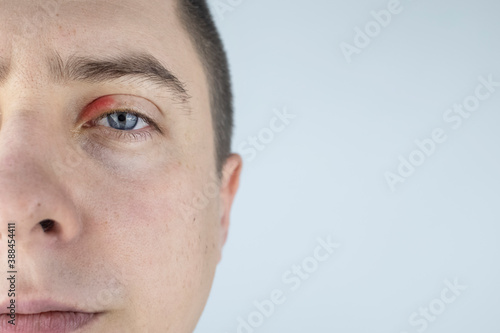 A man stands in front of a mirror and sees inflammation of the upper eyelid. Redness of the skin around the eyes and blepharitis.