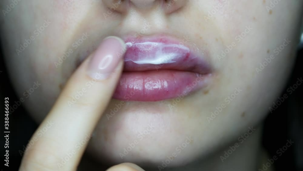 Closeup of swollen lips after injections of hyaluron, lips
