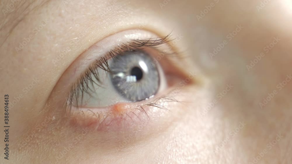 Young woman with hordeolum disease in the eye. Young woman with hordeolum disease in the eye.