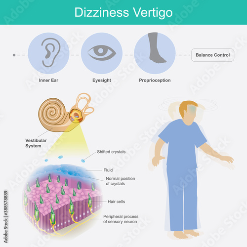 Dizziness Vertigo. Illustration explain dizziness vertigo by cause of crystals can float into the wrong part of the inner ear canal.. photo