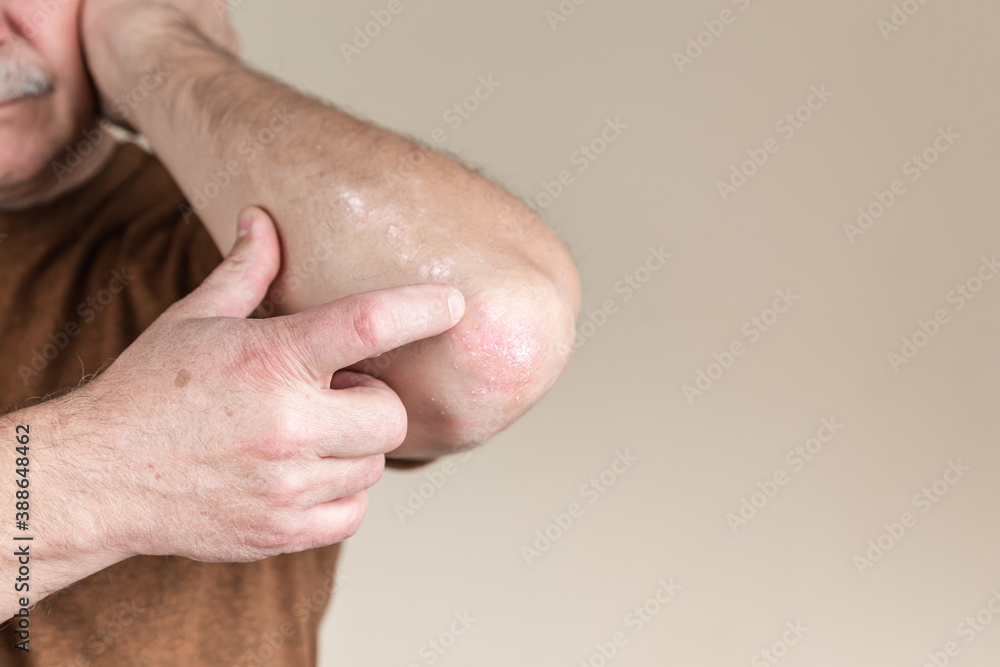Fototapeta premium Psoriasis on the elbow. Closeup dermatitis on skin ill allergic rash dermatitis eczema of patient atopic dermatitis symptom skin detail texture, Fungus concept dermatology, treatment fungal and fungal