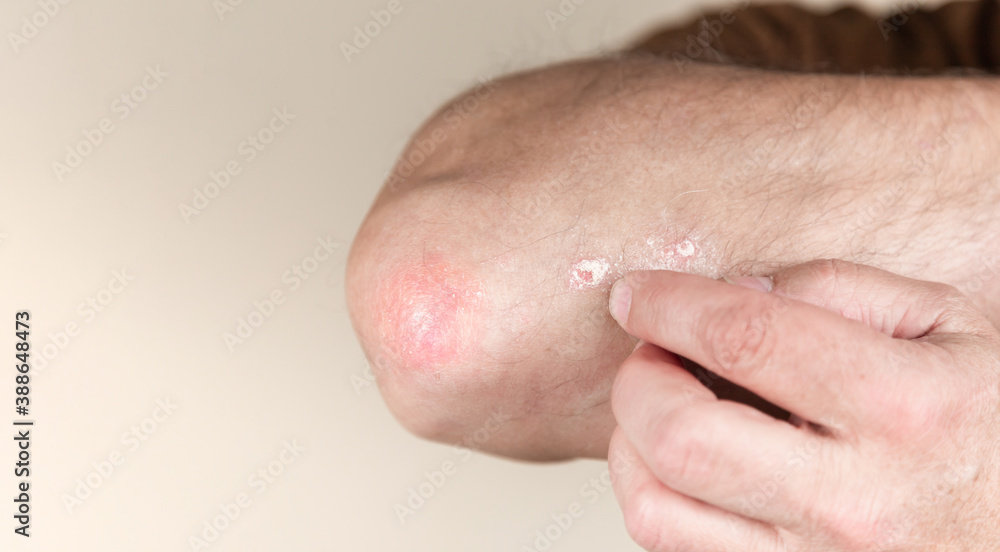 Psoriasis on the elbow. Closeup dermatitis on skin ill allergic rash dermatitis eczema of patient atopic dermatitis symptom skin detail texture, Fungus concept dermatology, treatment fungal and fungal Psoriasis on the elbow. Closeup dermatitis on skin ill allergic rash dermatitis eczema of patient atopic dermatitis symptom skin detail texture, Fungus concept dermatology, treatment fungal and fungal