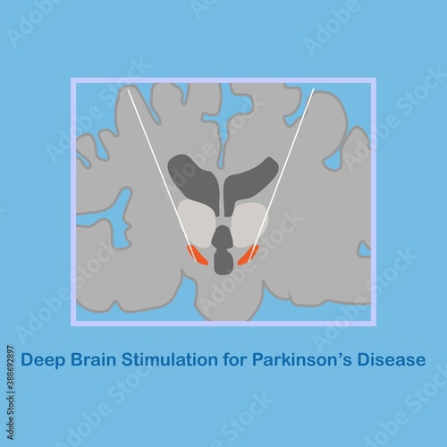 DBS at subthalamic nucleus for the treatment of parkinson's disease