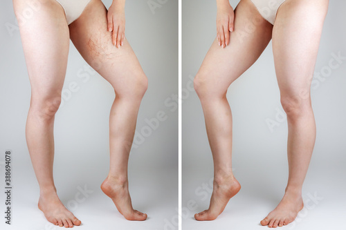 The concept of varicose veins and cosmetic treatment. The woman points to the vascular asterisks on the inner surface of the thigh. Legs close up. Gray background. Before and after concept photo