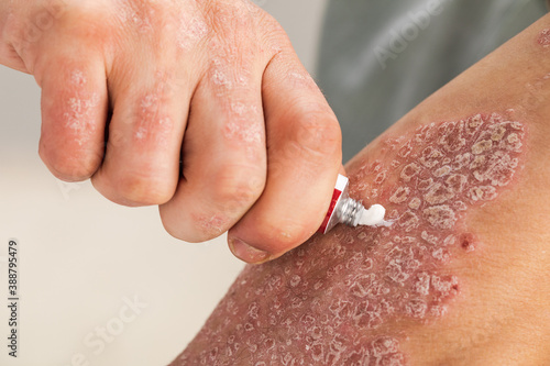 Photography the use of emollient for dry flaky skin, as in the treatment of psoriasis, eczema and other diseases of dry skin