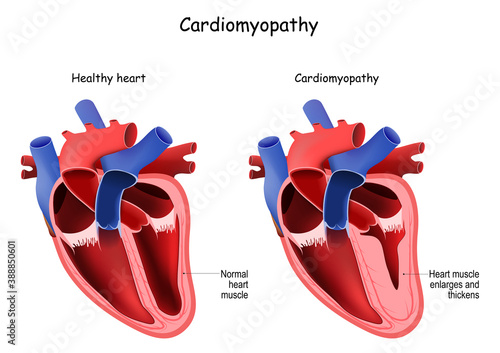 Cardiomyopathy. cross section of human's heart photo