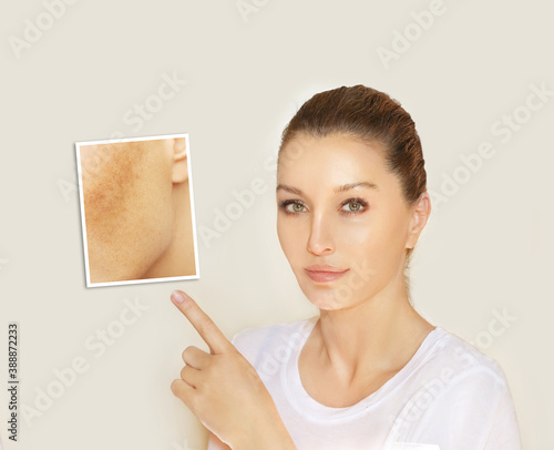 Dark spots, freckles,hyperpigmentation(melasma or chloasma),concept- skin lightening, skin whitening, Skin Brightening..