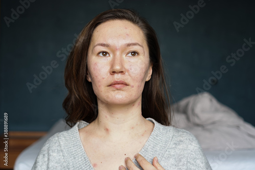 An adult woman infected with varicella virus at home photo