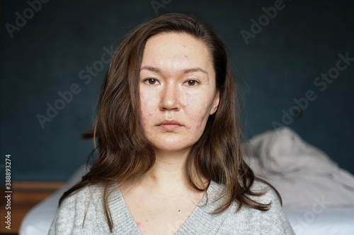 An adult woman infected with varicella virus at home