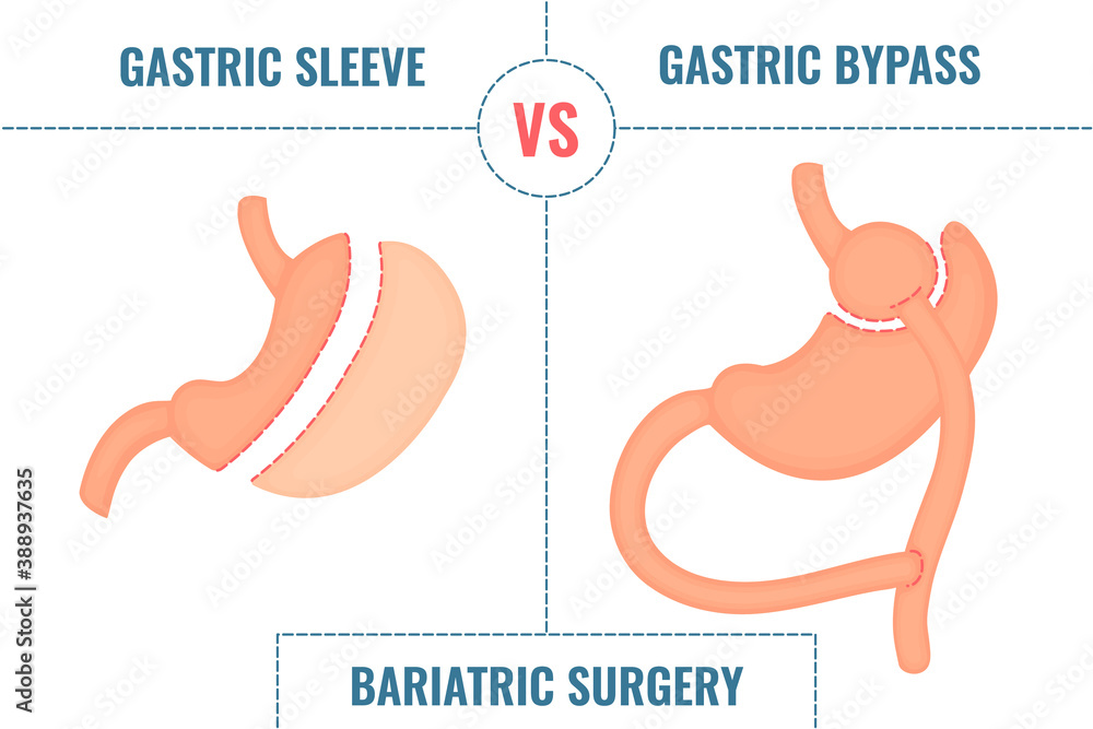 Gastric sleeve vs gastric bypass. Bariatric surgery weight loss