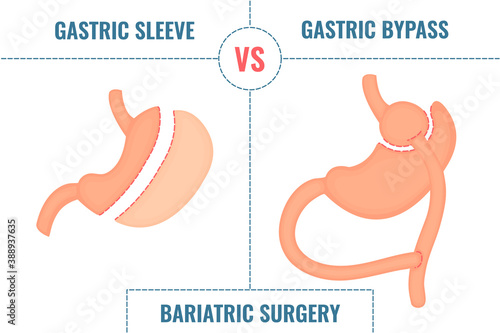 Gastric sleeve vs gastric bypass. Bariatric surgery weight loss procedures comparison. Stomach reduction anatomical diagram infographics. Health care  medical concept. Vector illustration.