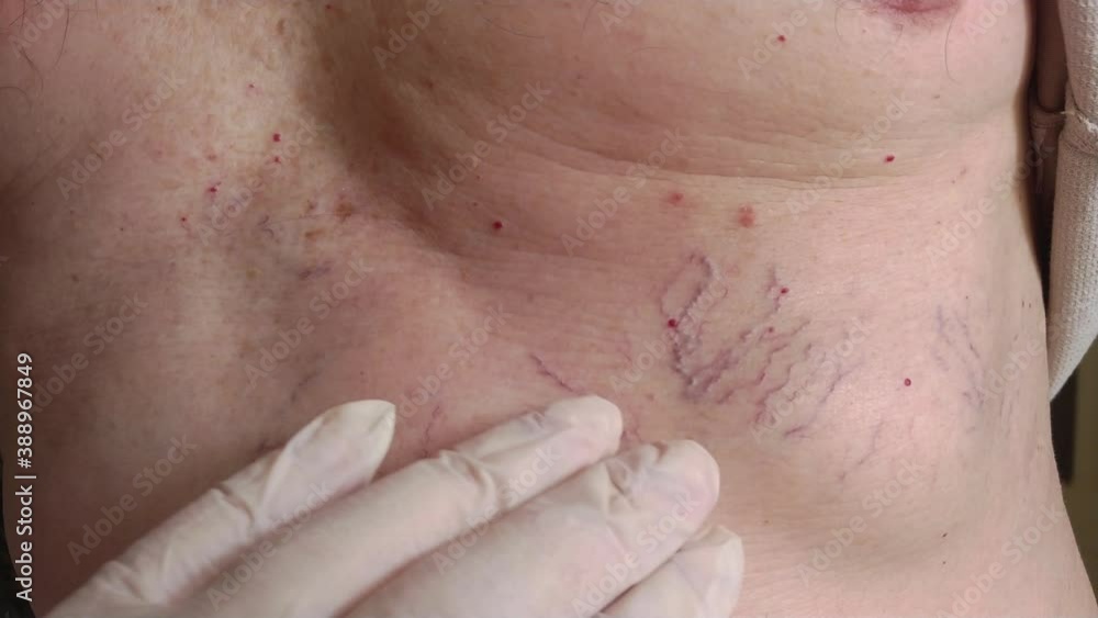 doctor palpating chest of senior old man patient with capillary mesh disease, solving heart cardiovascular problems. close up hands in disposable gloves 4k video footage doctor palpating chest of senior old man patient with capillary mesh disease, solving heart cardiovascular problems. close up hands in disposable gloves 4k video footage