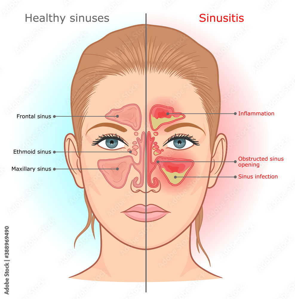 Sinusitis Infection And Normal Sinuses Medical Diagram Stock Vector 
