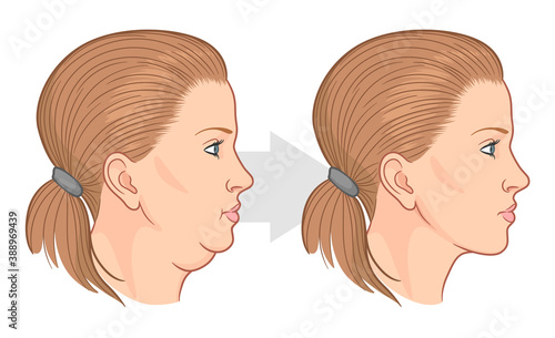 Double chin fat loss before and after vector illustration. 