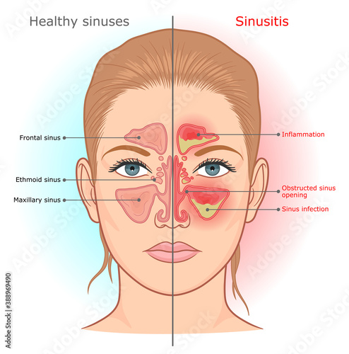 Sinusitis infection and normal sinuses medical diagram. 