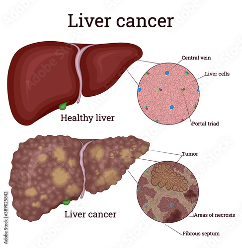 Comparative image of healthy liver and liver with cancer