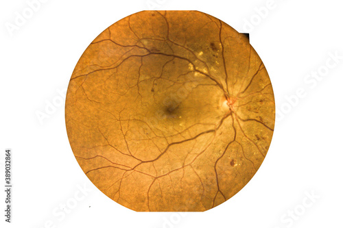 Fundus photography Madical Retina Abnormal isolated on white background.