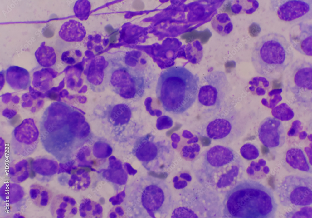 Mesothelial cells in body fluid sample. Mesothelial cells in body fluid sample.