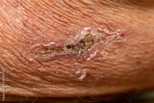 Closeup of flaking scab on wrinkled skin photo