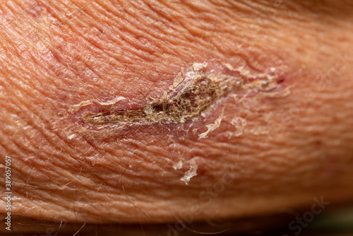 Tableau sur toile Closeup of flaking scab on wrinkled skin