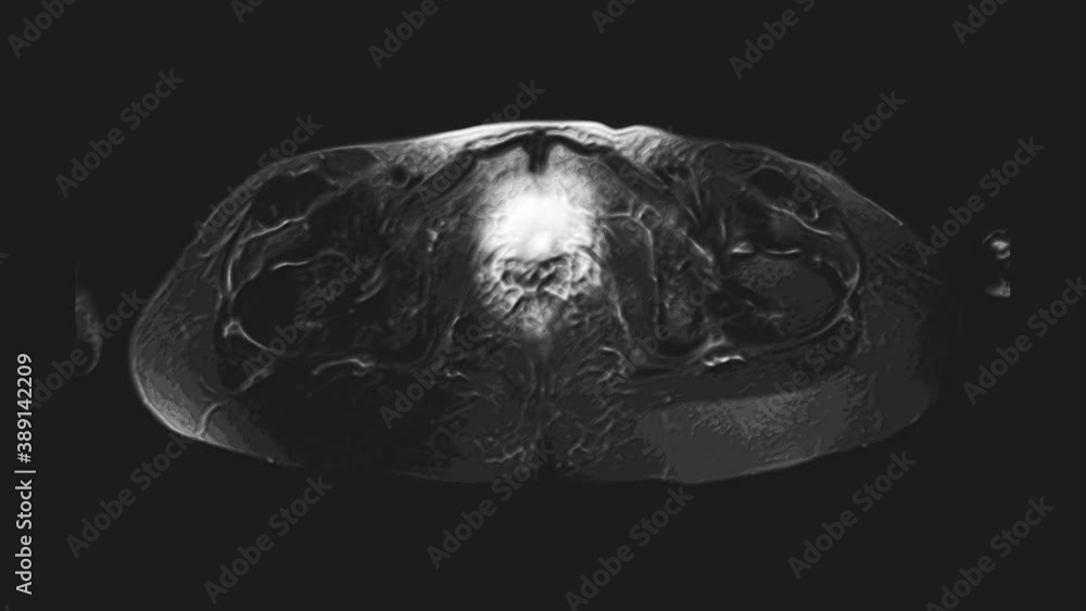 Voluminous MRI of the female pelvic organs, abdominal cavity, gastrointestinal tract and bladder Voluminous MRI of the female pelvic organs, abdominal cavity, gastrointestinal tract and bladder