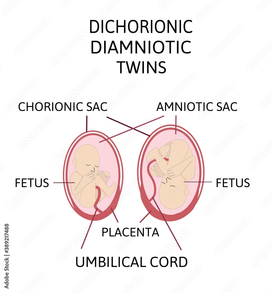 Fototapeta premium Anatomy of abdomen with twins. Twin types infographic elements in flat design. Monozygotic or Dizygotic Placentation of twins medical illustration and icons isolated on white background