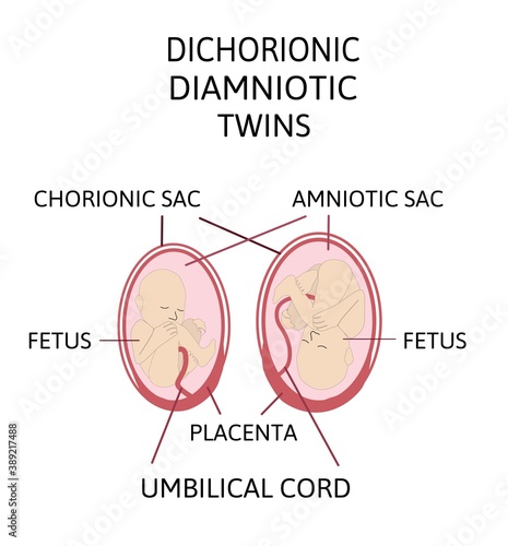 Anatomy of abdomen with twins. Twin types infographic elements in flat design. Monozygotic or Dizygotic Placentation of twins medical illustration and icons isolated on white background