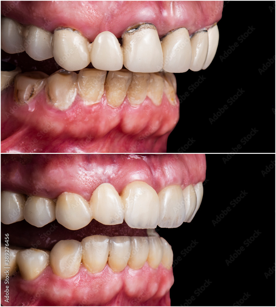 before and after picture of full mought reconstraction by crowns implants and veneers before and after picture of full mought reconstraction by crowns implants and veneers