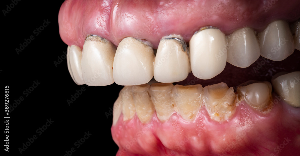 old metal ceramic crowns and bridges before replacing old metal ceramic crowns and bridges before replacing