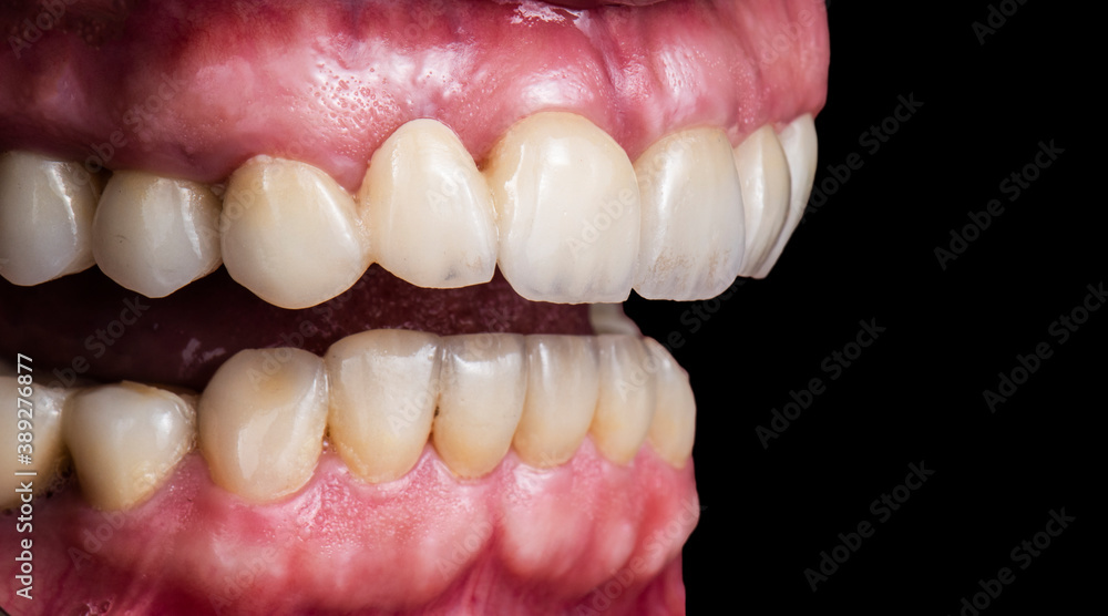 picture of full mought reconstraction by crowns implants and veneers picture of full mought reconstraction by crowns implants and veneers