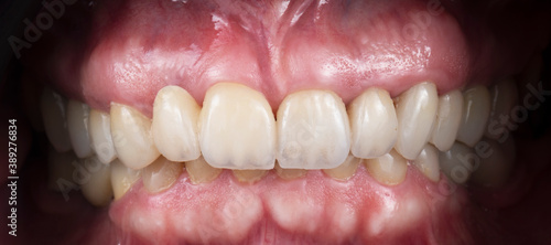 press ceramic crowns and red gums