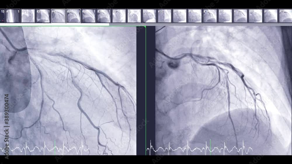Coronary angiography is a test used to find out how much narrowing