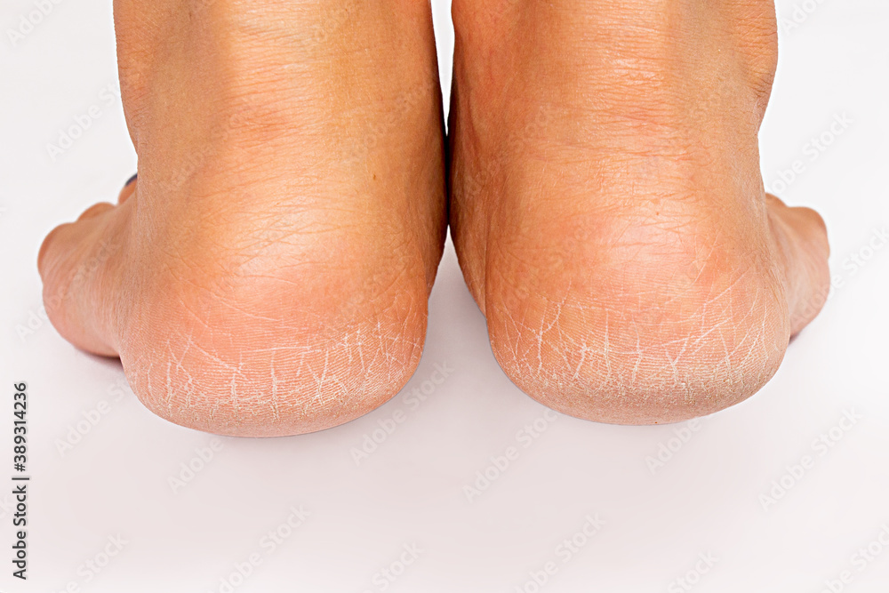Fototapeta premium Close up cracked heels in women isolated on white background