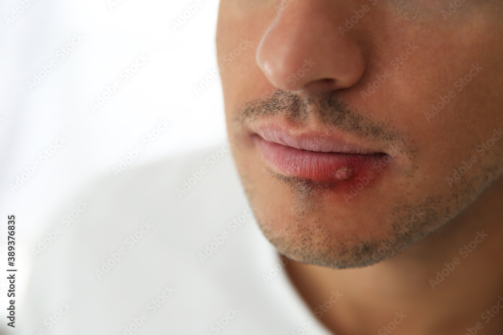 Man with herpes on lip against light background, closeup. Space for text Man with herpes on lip against light background, closeup. Space for text