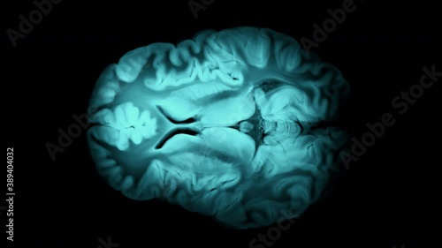 Top View Brain With Alpha Matte. Neurological Diseases, Tumors And Brain Surgery	