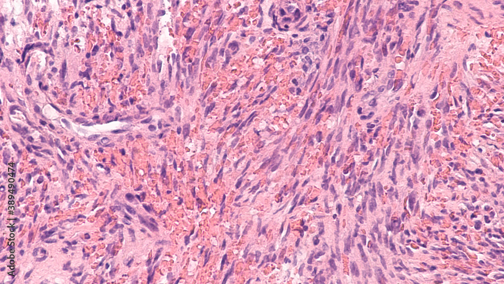 Fototapeta Kaposi's is a type of cancer of blood vessels caused