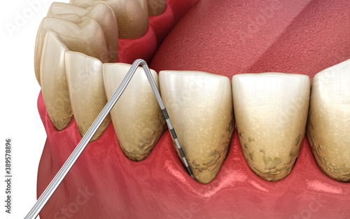 Periodontitis testing, gum recession process. Medically accurate 3D illustration photo