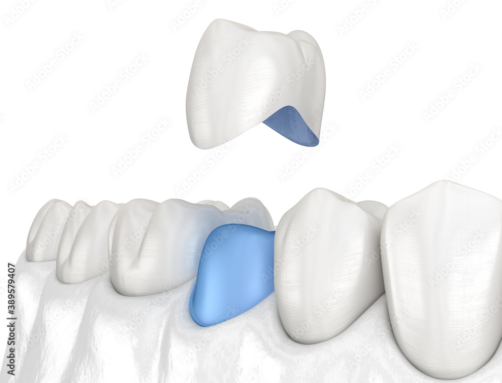 Porcelain crown placement over premolar tooth. Medically accurate 3D illustration Porcelain crown placement over premolar tooth. Medically accurate 3D illustration