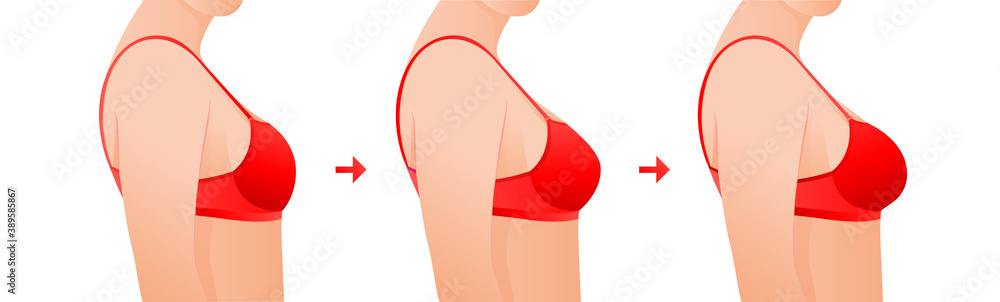 Vecteur Stock Female breasts in bra before and after augmentation