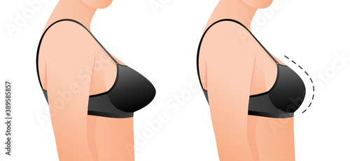 Female breasts in bra before and after augmentation/ breast size correction. Plastic surgery concept.woman body changing from overweight to slim as a result of training, dieting or Fitness workout.