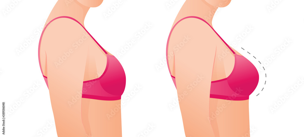 Female breasts in bra before and after augmentation breast size