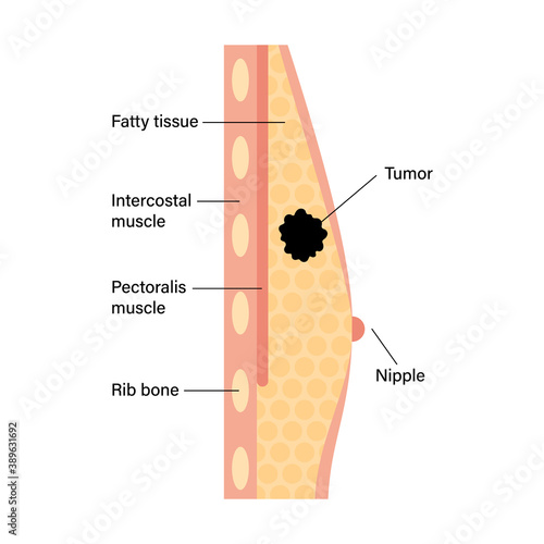 Breast disease concept