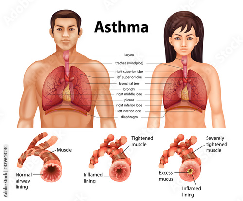 Comparison of healthy lung and Asthmatic lung
