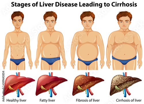 Stages of liver disease leading to Cirrhosis
