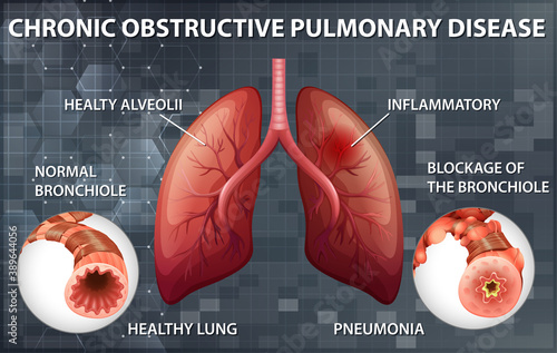 Chronic obstructive pulmonary disease