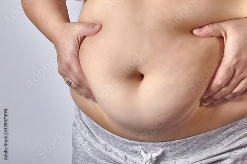 female fat belly with striae closer to 40 years